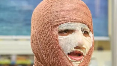 شناخت انواع سوختگی در حملات هوایی در شرایط جنگی