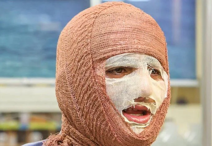 شناخت انواع سوختگی در حملات هوایی در شرایط جنگی