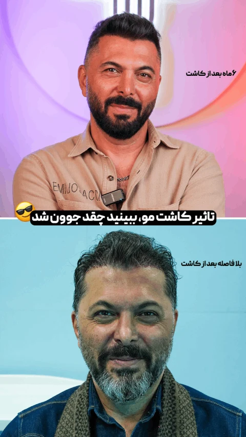 کاشت مو بدون کوتاهی مو برای نخستین بار در ایران کاشت مو بدون کوتاهی مو برای نخستین بار در ایران
