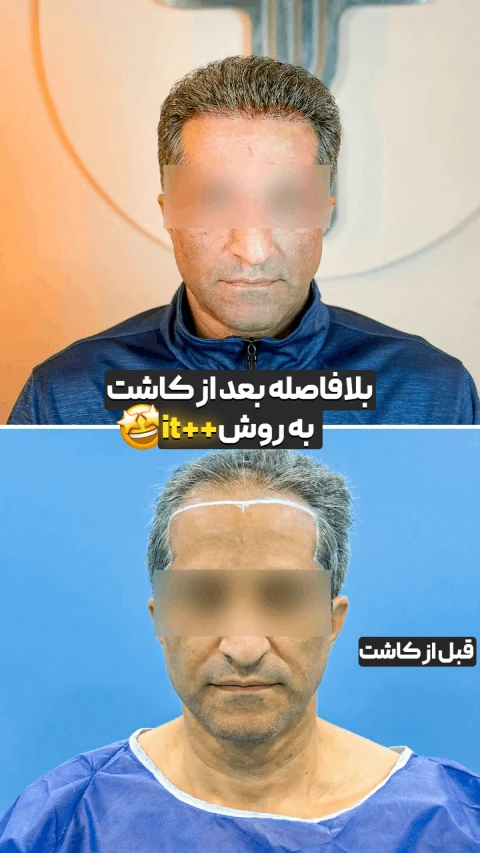 کاشت مو بدون کوتاهی مو برای نخستین بار در ایران کاشت مو بدون کوتاهی مو برای نخستین بار در ایران